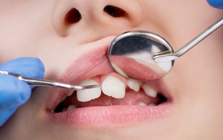 Dlaczego stomatolog dziecięcy stosuje inne metody leczenia niż stomatolog ogólny?
